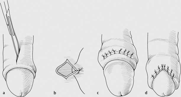Radikale beschneidung mit frenulum entfernung