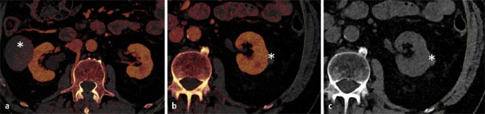 Schnittbildgebung Der Nierentumoren Springerlink