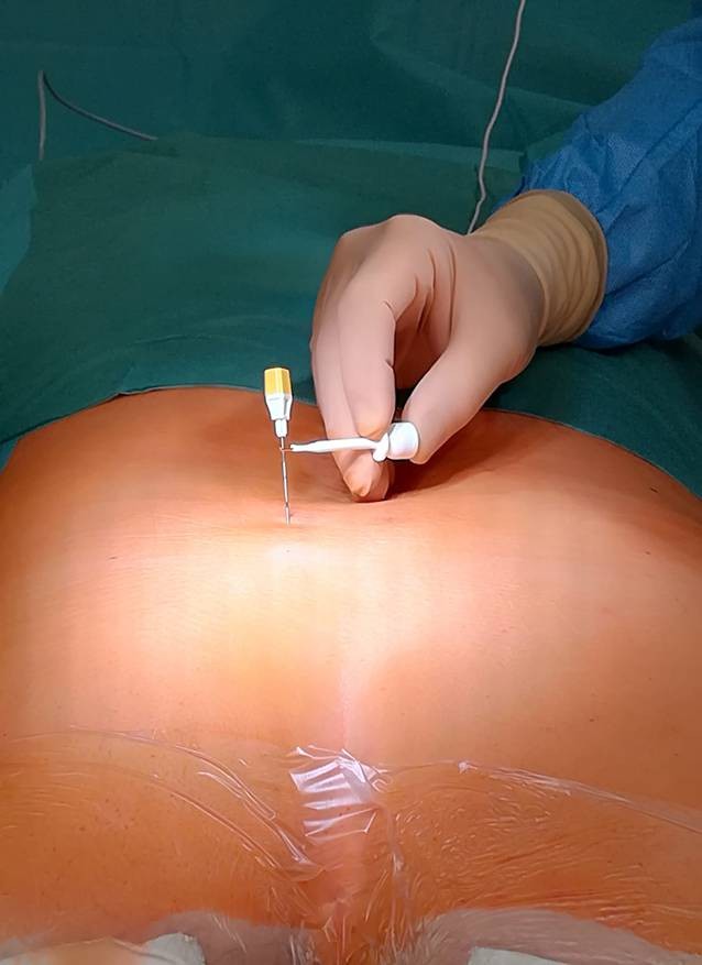 Sakrale Neuromodulation Bei Refraktarer Uberaktiver Blase Springerlink