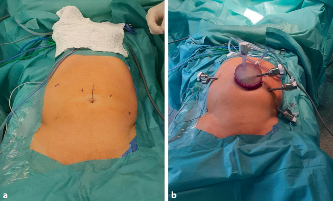 Aktuelles zur robotischen Nierentransplantation  quo vadis? | Die Urologie  | Springer Nature Link