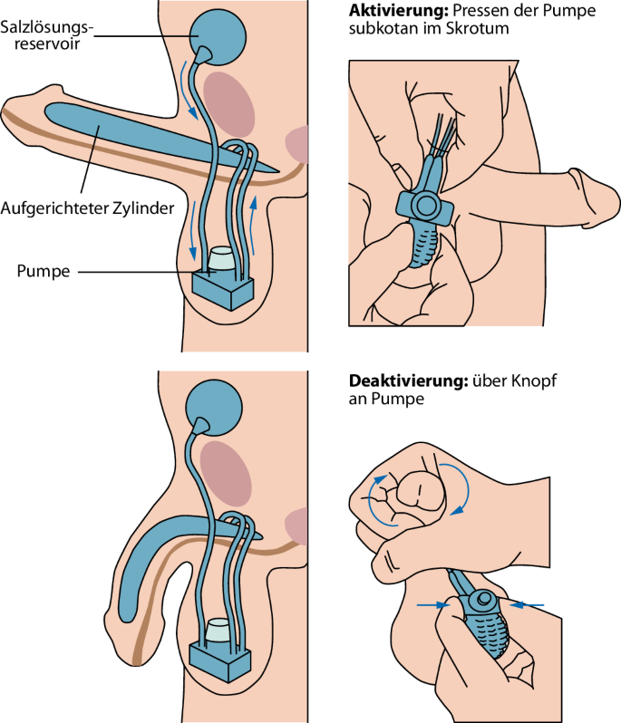 Erektile Dysfunktion  es ist Zeit zum Handeln! | Die Urologie | Springer  Nature Link
