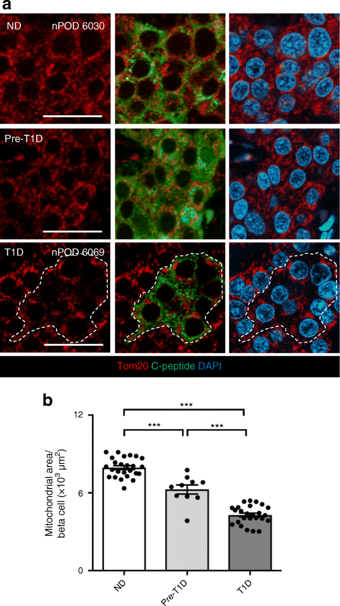 Activation Of The Hif1a Pfkfb3 Stress Response Pathway In Beta Cells In Type 1 Diabetes Springerlink