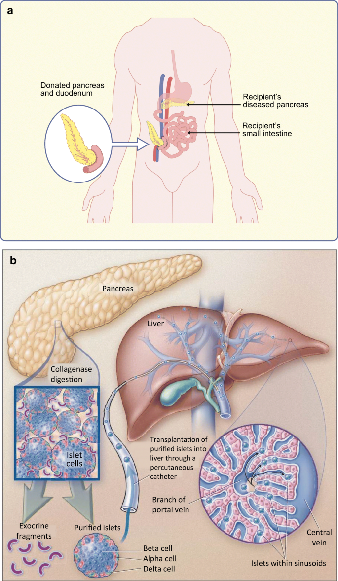 transplant strategies for type 1 diabetes whole pancreas islet and porcine beta cell therapies springerlink