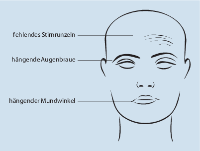 Einseitige Gesichtslahmung In Der Schwangerschaft Springerlink