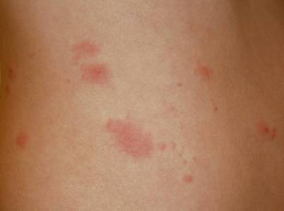 Durch stress herpes
