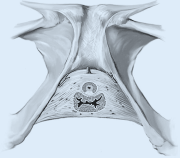 Vagina weite Pinworms (threadworms):