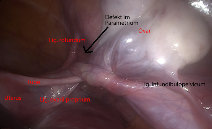 Akutes Abdomen In Der 21 Schwangerschaftswoche Springerlink