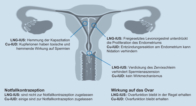 Weiterentwicklung intrauteriner Kontrazeptionssysteme | SpringerLink