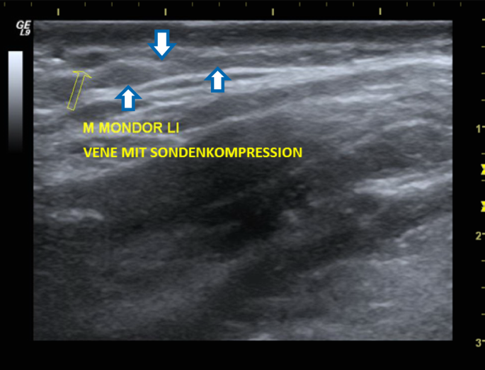 Was ist eine oberflächliche thrombophlebitis