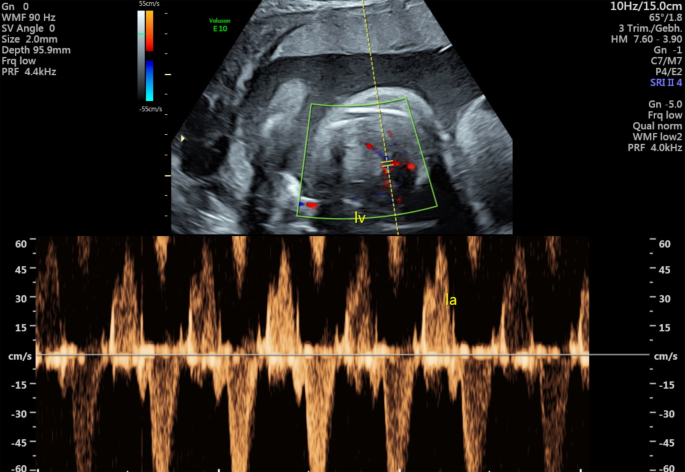 Herztumor des zweiten Feten bei dichorialer-diamnioter Geminigravidität |  SpringerLink