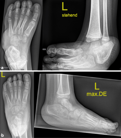 erwachsenen club foot