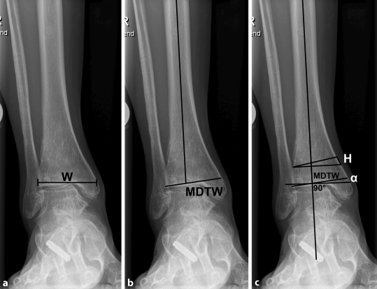 Supramalleolare Osteotomie Bei Asymmetrischer Arthrose Des Oberen Sprunggelenks Springerlink Supramalleolare Osteotomie Bei Asymmetrischer Arthrose Des Oberen Sprunggelenks Springerlink