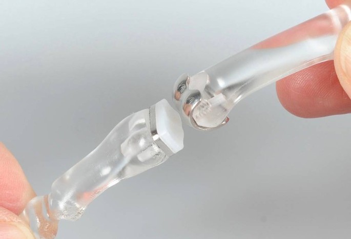 Gelenkersatz am Fingermittelgelenk | Die Orthopdie | Springer Nature Link