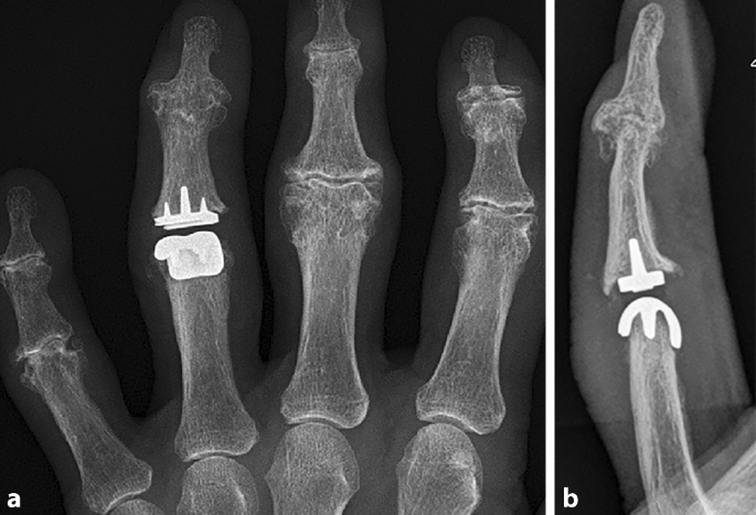 Gelenkersatz am Fingermittelgelenk | Die Orthopdie | Springer Nature Link