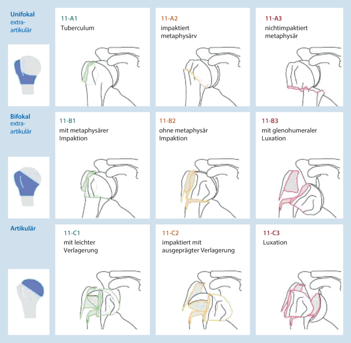 Schulterendoprothetik | Die Orthopdie | Springer Nature Link