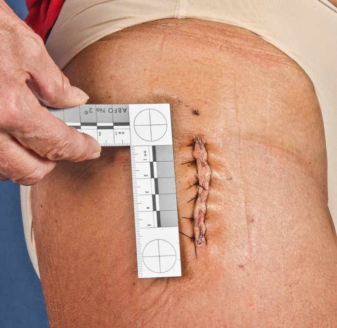 Fast-Track in der Hft- und Kniegelenkendoprothetik | Die Orthopdie |  Springer Nature Link