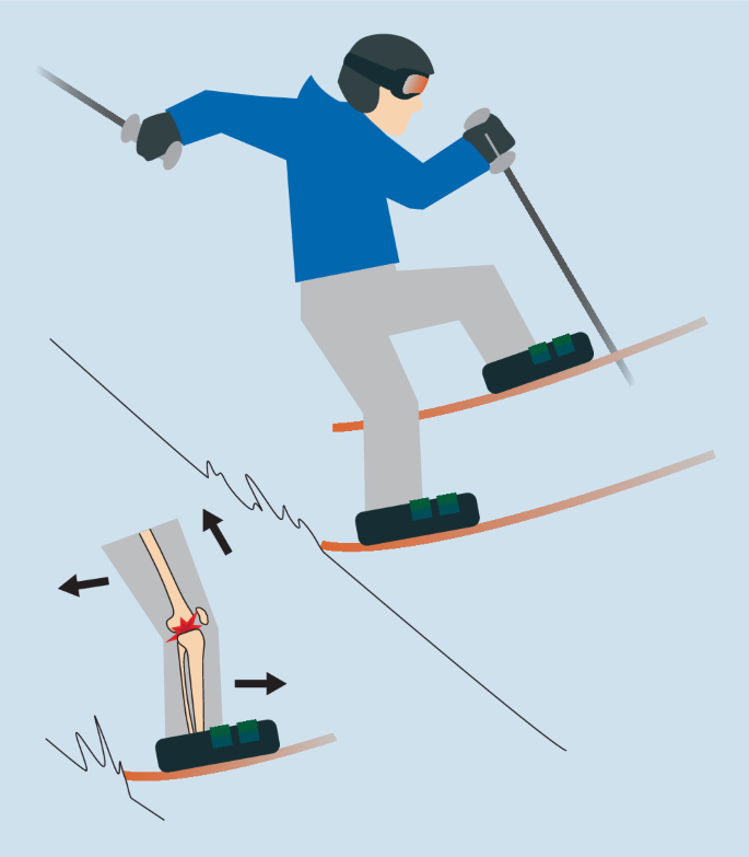 Wintersportverletzungen am Kniegelenk | Die Orthopädie