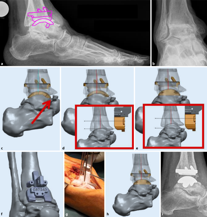 Update: Endoprothetik am oberen Sprunggelenk | Die Orthopdie | Springer  Nature Link