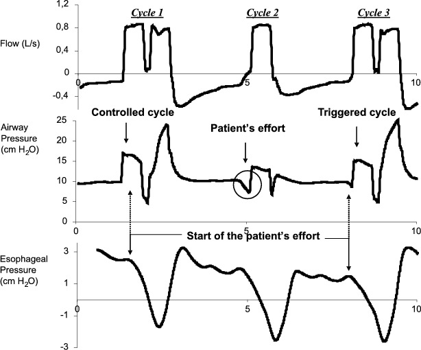 Double triggering during assisted mechanical ventilation: Is it a  controlled, auto-triggered or patient-triggered cycle? Reply to C.-W. Chen  | SpringerLink