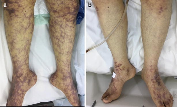 Nursing Paper Example on Cold Agglutinin Disease