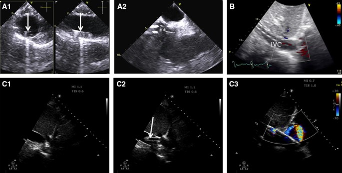 A Decade Of Progress In Critical Care Echocardiography A Narrative Review Springerlink