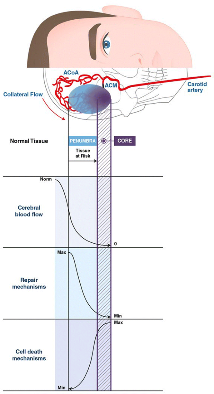 Acute ischaemic stroke: challenges for the intensivist | SpringerLink