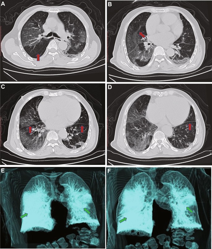 Shown are chest CT scans obtained at admission (onset the fifth day) in the...