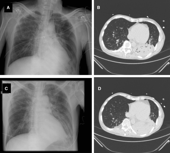 Ventilator-associated pneumonia in adults: a narrative review | SpringerLink