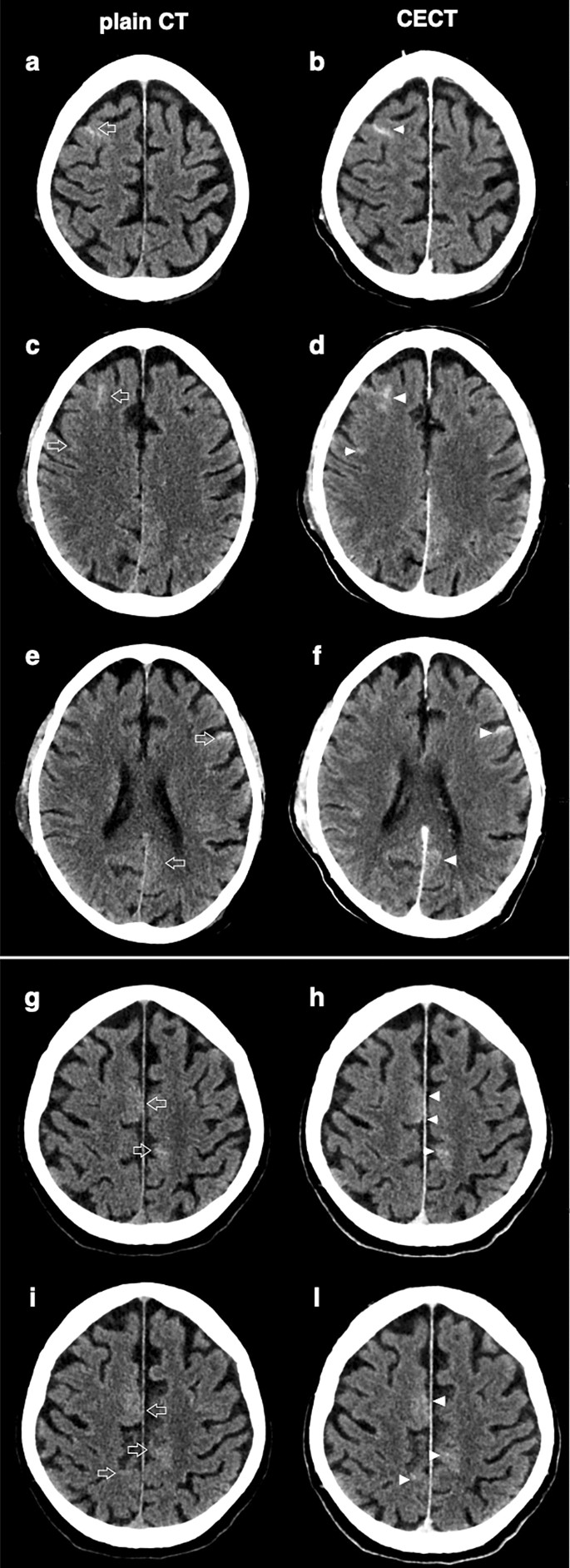 Pathological Brain Ct Scans In Severe Covid 19 Icu Patients Springerlink