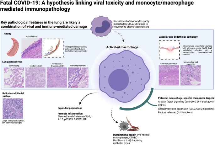 Post Mortem Dissection Of Covid 19 A Pathogenic Role For Macrophages Springerlink