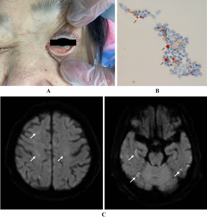 Fat Embolism Syndrome Springerlink