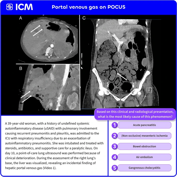 [Intensive Care Med影像]：床旁超声显示的门静脉积气