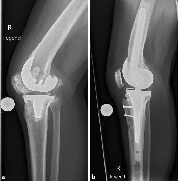 Postoperatives steifes Kniegelenk nach Knieprothese | Arthroskopie |  Springer Nature Link