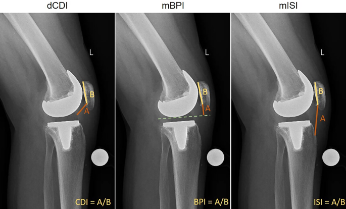 Chirurgische Optionen zur Behandlung einer Patella baja | Arthroskopie |  Springer Nature Link