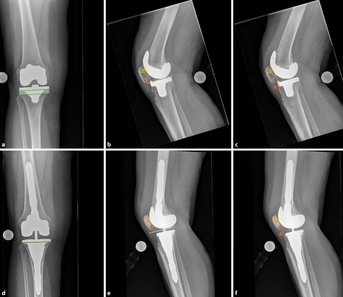 Chirurgische Optionen zur Behandlung einer Patella baja | Arthroskopie |  Springer Nature Link