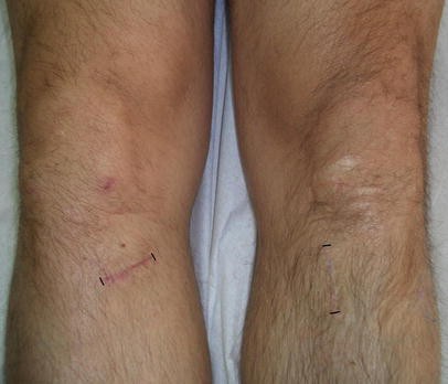 Injuries To The Infrapatellar Branch Es Of The Saphenous Nerve In Anterior Cruciate Ligament Reconstruction With Four Strand Hamstring Tendon Autograft Vertical Versus Horizontal Incision For Harvest Springerlink