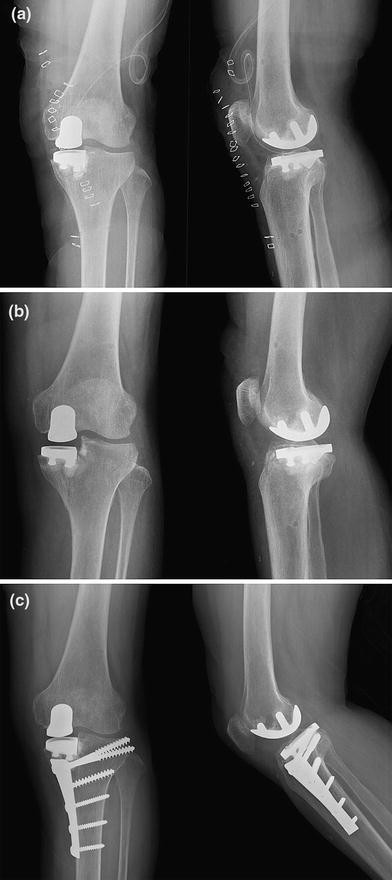 Tibial plateau stress fracture after unicondylar knee arthroplasty using a navigation system: two case reports | SpringerLink Tibial plateau stress fracture after unicondylar knee arthroplasty using a navigation system: two case reports | SpringerLink