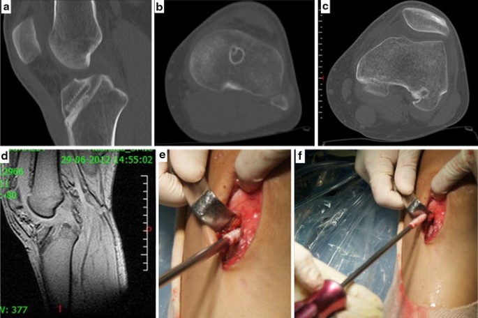 Migration Of Bioabsorbable Screws In Acl Repair How Much Do We Know A Systematic Review Springerlink