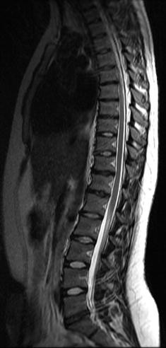 Disc Degeneration On Mri Is More Prevalent In Young Elite Skiers Compared To Controls Springerlink
