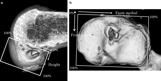 Shallow Knee Flexion Angle During Femoral Tunnel Creation Using Modified Transtibial Technique Can Reduce Femoral Graft Bending Angle In Acl Reconstruction Springerlink