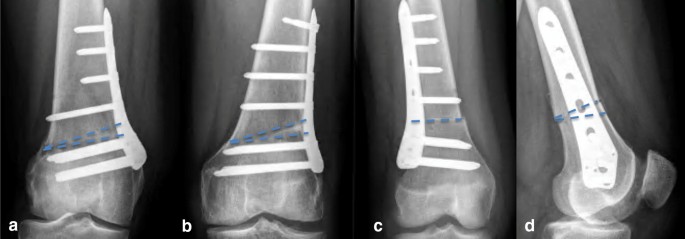 Остеотомия сустава что это. Корригирующая остеотомия бедра. Остеотомия сустава что это. Операция остеотомия бедренной кости. Корригирующая остеотомия тазобедренного сустава.