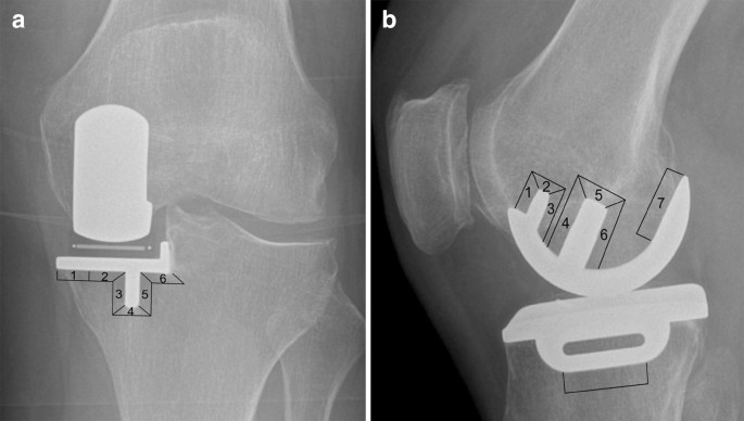 Ten-year clinical and radiographic results of 1000 cementless Oxford  unicompartmental knee replacements | SpringerLink