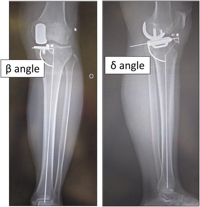 Accuracy Of Tibial Component Placement In Unicompartmental Knee Arthroplasty Performed Using An Accelerometer Based Portable Navigation System Springerlink