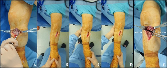 Difference of preoperative varus–valgus stress radiograph is effective for  the correction accuracy in the preoperative planning during open-wedge high  tibial osteotomy | SpringerLink