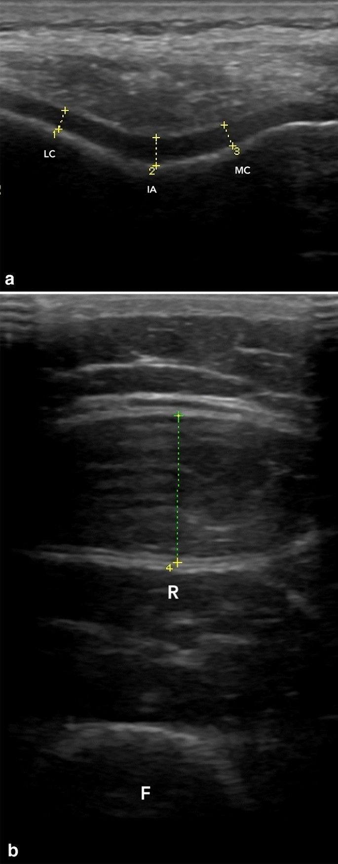 Mean Femoral Cartilage Thickness Is Higher In Athletes As Compared With Sedentary Individuals Springerlink