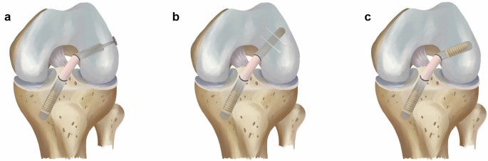 Interference Screws Are More Likely To Perform Better Than Cortical Button And Cross Pin Fixation For Hamstring Autograft In Acl Reconstruction A Bayesian Network Meta Analysis Springerlink Interference Screws Are More Likely To Perform Better Than Cortical Button And Cross Pin Fixation For Hamstring Autograft In Acl Reconstruction A Bayesian Network Meta Analysis Springerlink