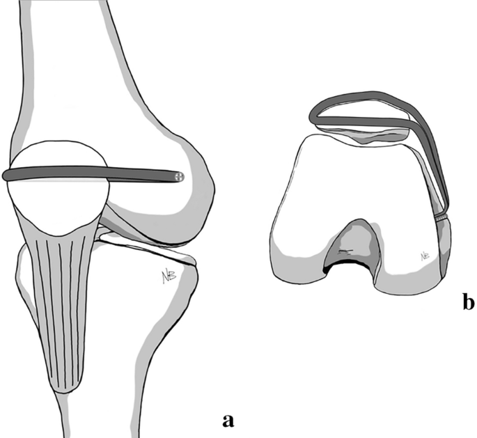 Single-tunnel and double-tunnel medial patellofemoral ligament  reconstructions have similar clinical, radiological and functional results  | SpringerLink
