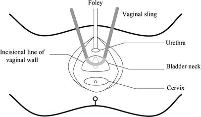 The Clinical And Urodynamic Effects Of The Tension Free Bladder