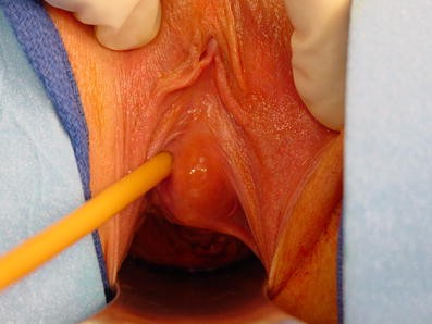 Surgical management of Skene's gland abscess/infection: a contemporary series | SpringerLink Surgical management of Skene's gland abscess/infection: a contemporary series | SpringerLink