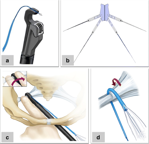 Anterior sacrospinous ligament fixation associated with paravaginal repair  using the Pinnacle™ device: an anatomical study | SpringerLink